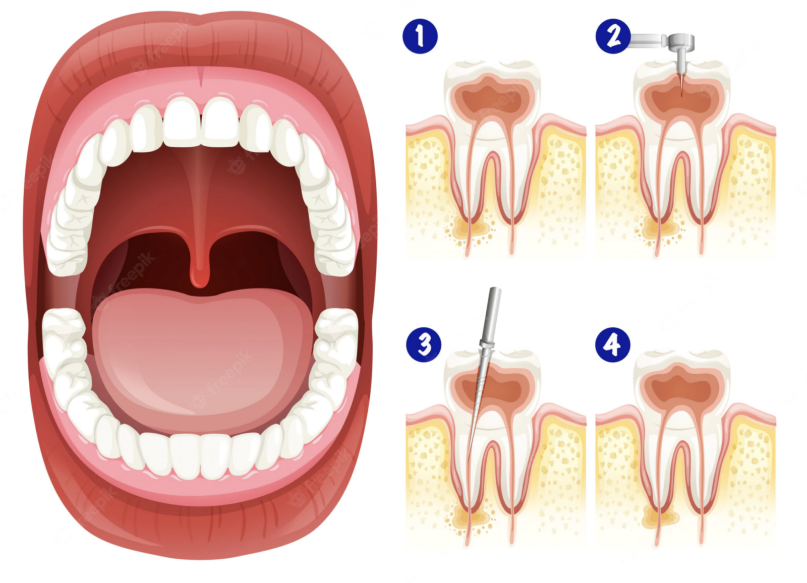 Diagram detailing root canal procedure